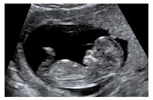 12 Недель Беременности Фото Узи Ребенка