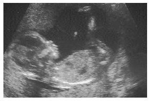 Ребенок В 14 Недель Беременности Фото